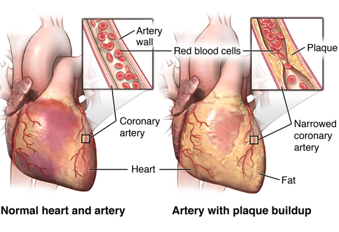 Coronary Artery Disease (CAD)