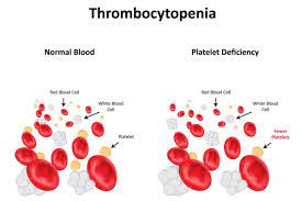 thrombocytopenia